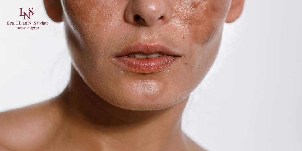 Qual a Importância do Protetor Solar para Melasma? 