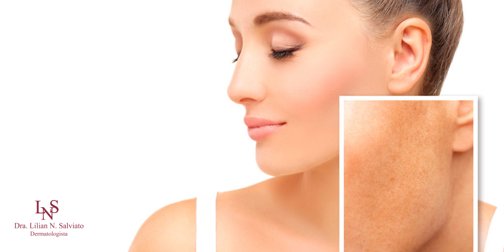 Qual a Importância do Protetor Solar para Melasma? 