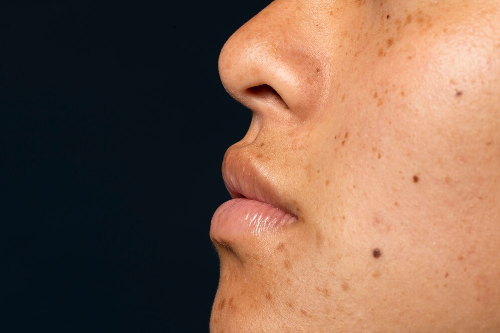 Melasma: Como Controlar as Manchas no Verão?