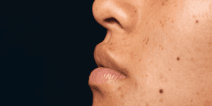 Manchas na Pele: Como Evitar, Tratar e Quando Procurar Um Dermatologista