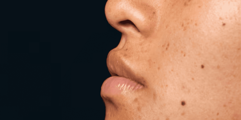 Read more about the article Manchas na Pele: Como Evitar, Tratar e Quando Procurar Um Dermatologista