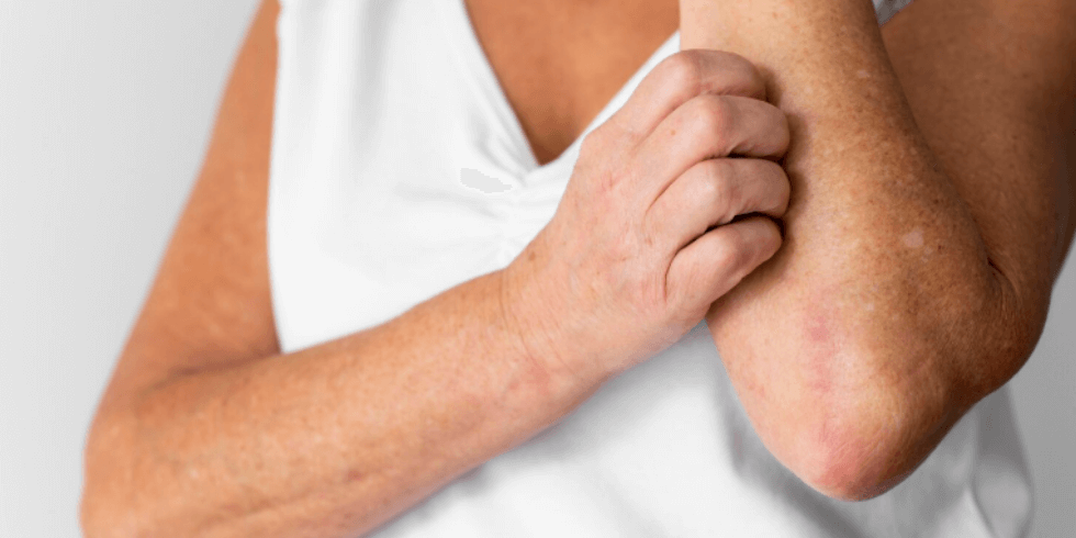 Cuidados Dermatológicos Essenciais para Psoríase no Verão