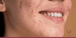 Por que as Manchas de Acne Escurecem no Verão?