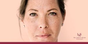 Qual o Melhor Tratamento para Melasma? Descubra Como Clarear as Manchas