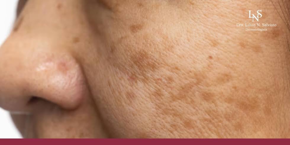 Read more about the article 5 Erros Que Pioram o Melasma no Dia a Dia e Como Evitá-los